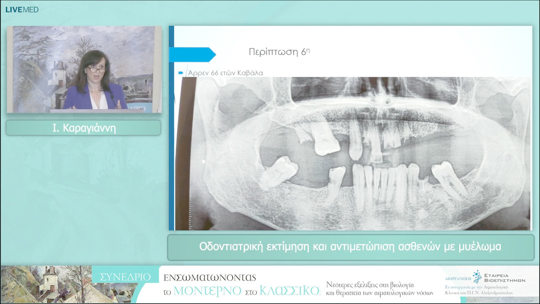 32 Ι. Καραγιάννη - Οδοντιατρική εκτίμηση και αντιμετώπιση ασθενών με μυέλωμα 