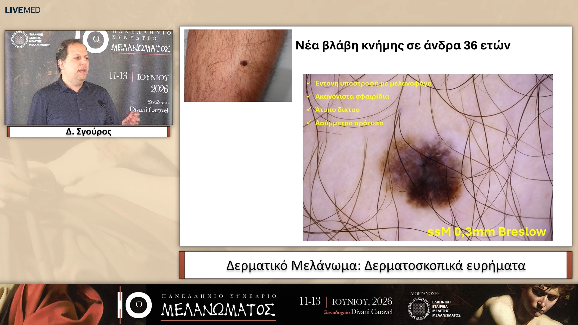 09 Δ. Σγούρος - Δερματικό Μελάνωμα: Δερματοσκοπικά ευρήματα 