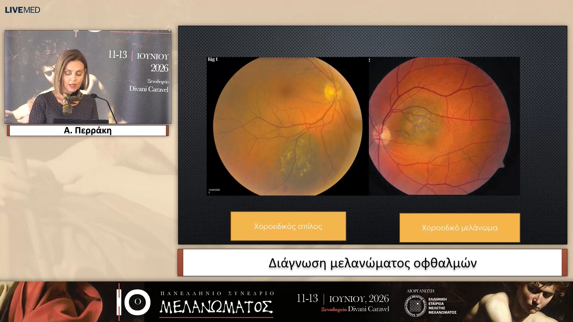 11 Α. Περράκη - Διάγνωση μελανώματος οφθαλμών