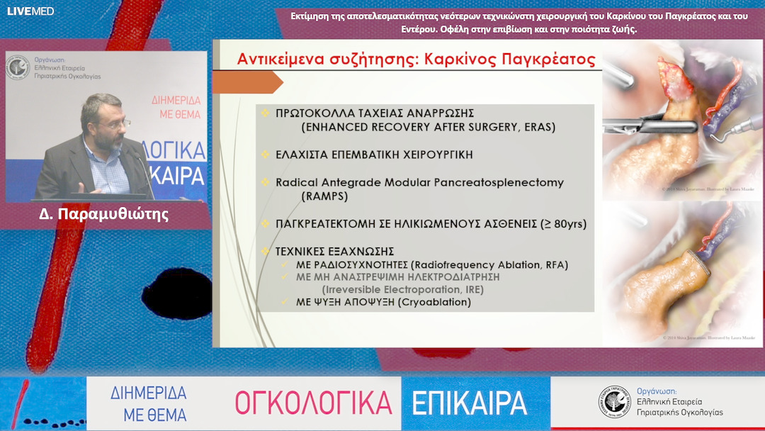 30 Δ. Παραμυθιώτης - Εκτίμηση της αποτελεσματικότητας νεότερων τεχνικών στη χειρουργική του Καρκίνου του Παγκρέατος και του Εντέρου. Οφέλη στην επιβίωση και στην ποιότητα ζωής.