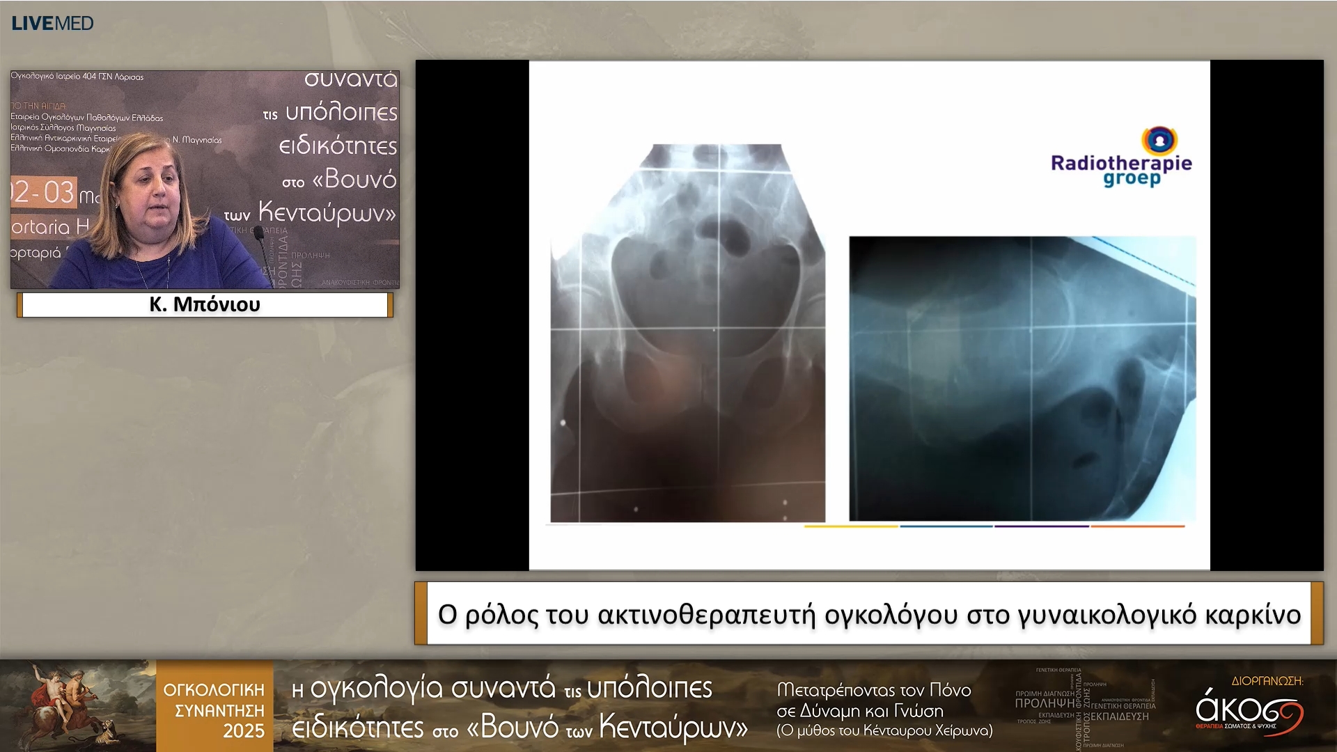 41 Κ. Μπόνιου - Ο ρόλος του ακτινοθεραπευτή ογκολόγου στο γυναικολογικό καρκίνο