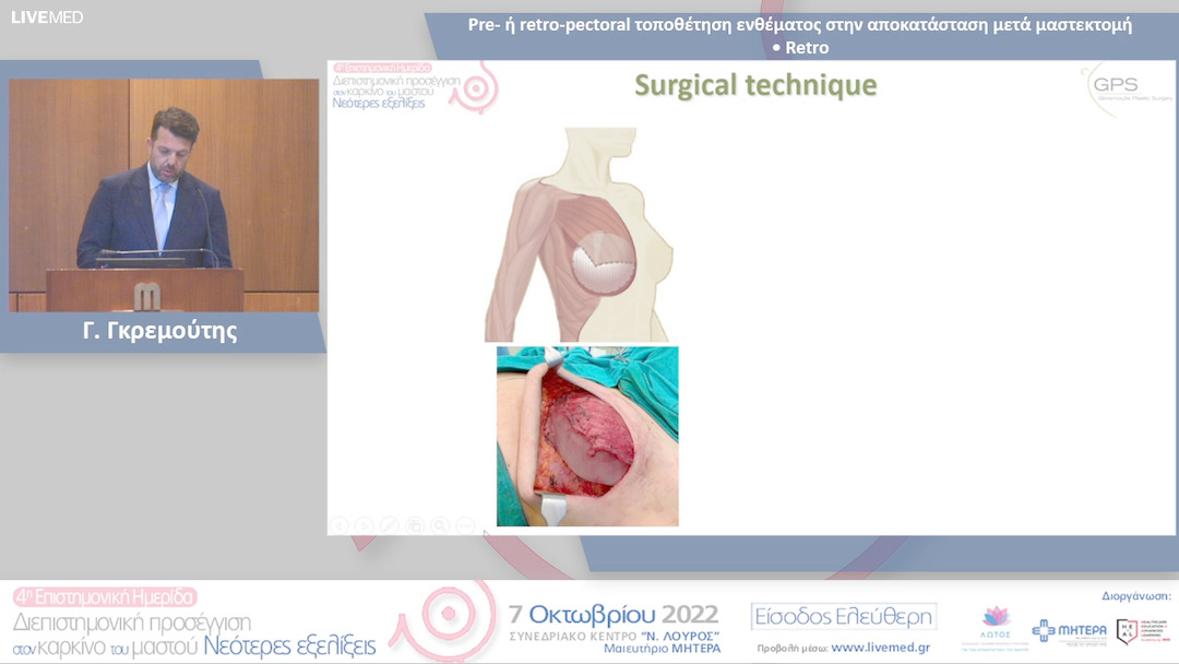 18 Γ. Γκρεμούτης - Pre- ή retro-pectoral τοποθέτηση ενθέματος στην αποκατάσταση μετά μαστεκτομή • Retro 