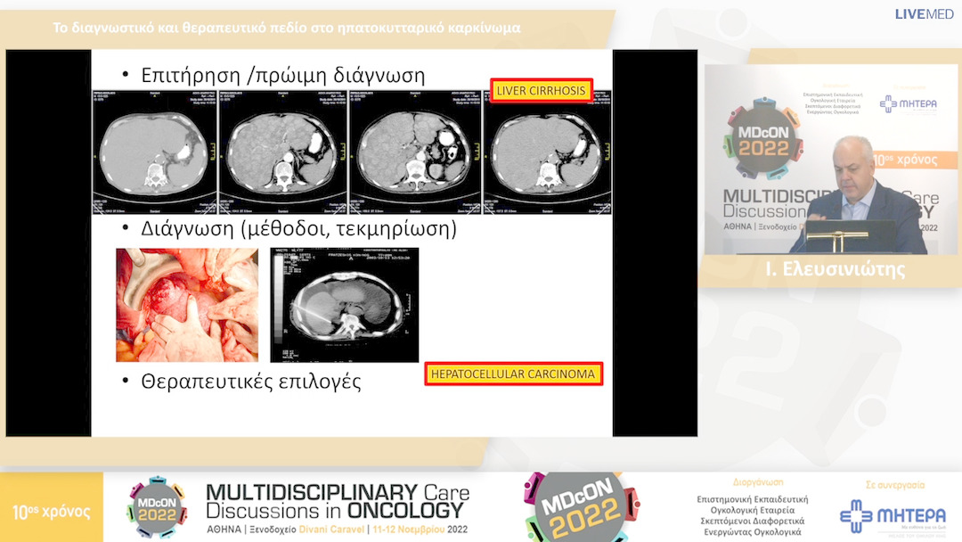 25 Ι. Ελευσινιώτης - Το διαγνωστικό και θεραπευτικό πεδίο στο ηπατοκυτταρικό καρκίνωμα 
