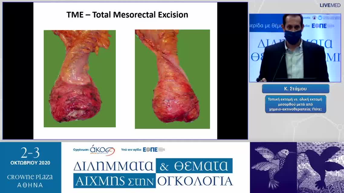 33 Κ. Στάμου  - Τοπική εκτομή vs. ολική εκτομή μεσορθού μετά από χημειο-ακτινοθεραπεία; Πότε; 