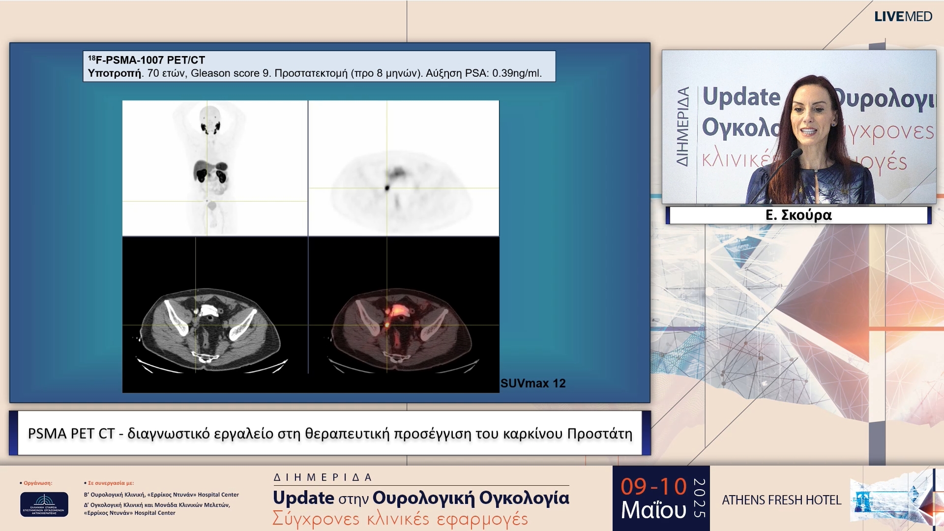 33 Ε. Σκούρα - PSMA PET CT - διαγνωστικό εργαλείο στη θεραπευτική προσέγγιση του καρκίνου Προστάτη