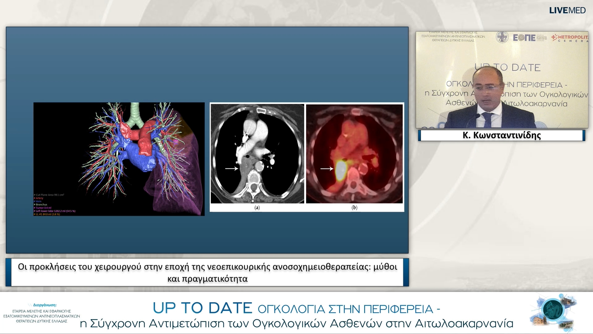 17 Κ. Κωνσταντινίδης - Οι προκλήσεις του χειρουργού στην εποχή της νεοεπικουρικής ανοσοχημειοθεραπείας: μύθοι και πραγματικότητα