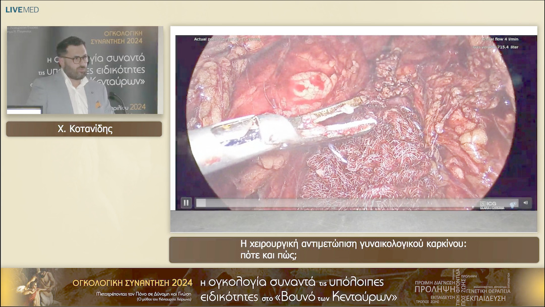 18 Χ. Κοτανίδης - H xειρουργική αντιμετώπιση γυναικολογικού καρκίνου: πότε και πώς; 