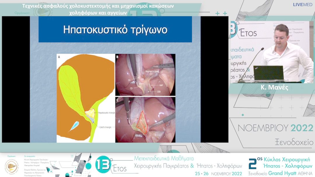 03 Κ. Μανές - Τεχνικές ασφαλούς χολοκυστεκτομής και μηχανισμοί κακώσεων χοληφόρων και αγγείων