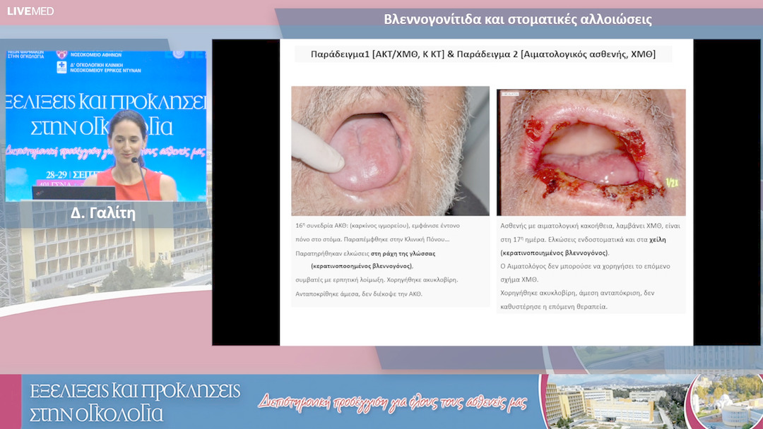 23 Δ. Γαλίτη - Βλεννογονίτιδα και στοματικές αλλοιώσεις