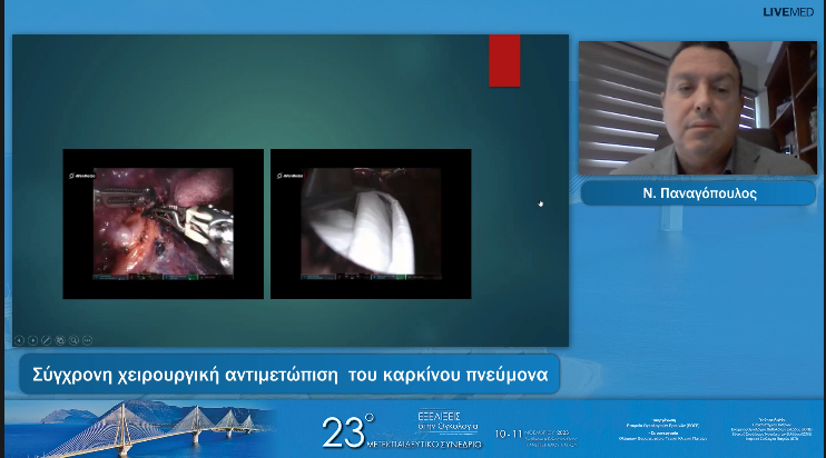 27 Ν. Παναγόπουλος - Σύγχρονη χειρουργική αντιμετώπιση  του καρκίνου πνεύμονα 