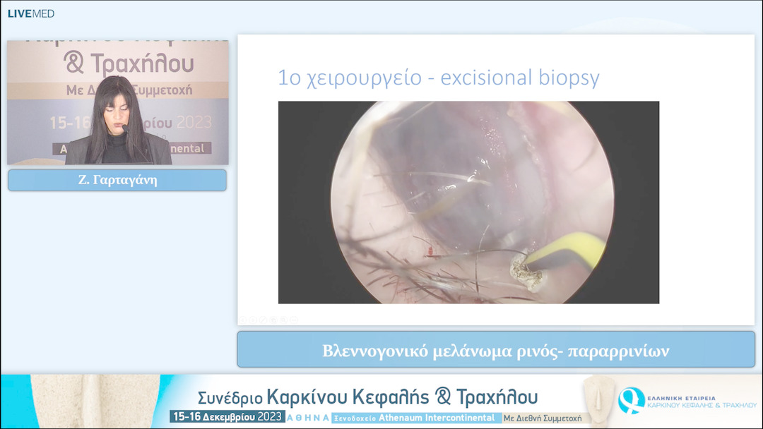 30 Ζ. Γαρταγάνη - Βλεννογονικό μελάνωμα ρινός- παραρρινίων 