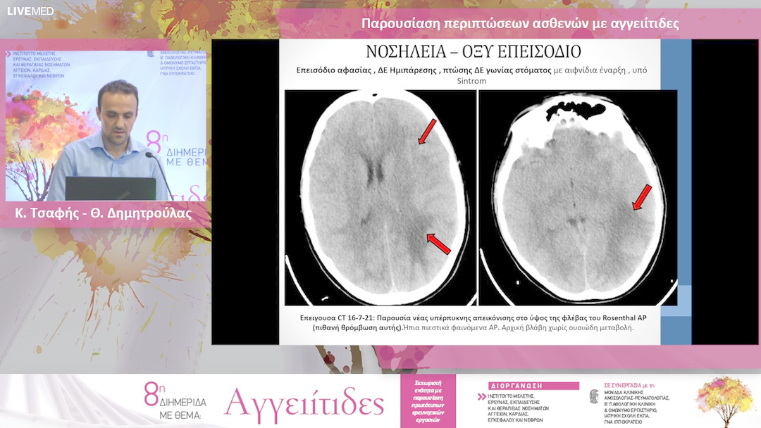 24 Κ. Τσαφής - Θ. Δημητρούλας - Παρουσίαση περιπτώσεων ασθενών με αγγειίτιδες