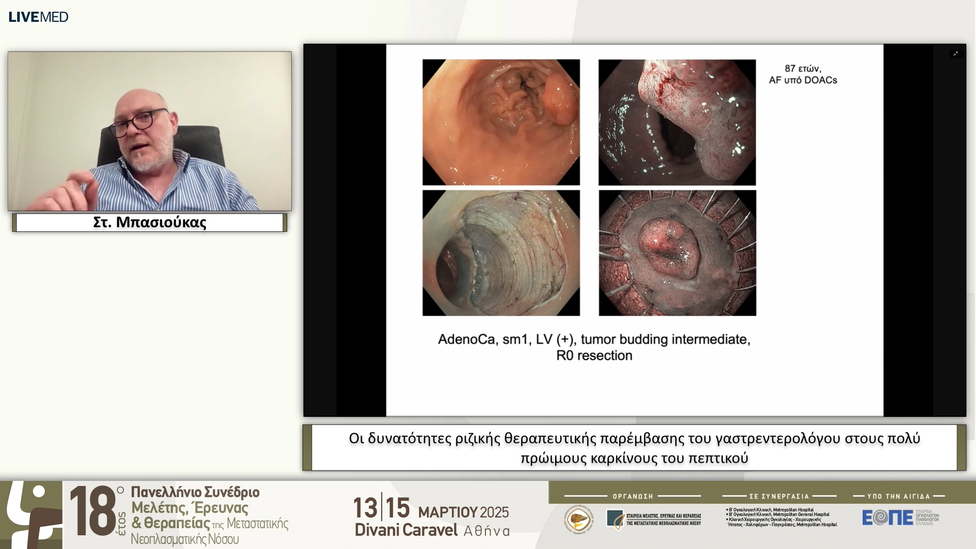 41 Στ. Μπασιούκας - Οι δυνατότητες ριζικής θεραπευτικής παρέμβασης του γαστρεντερολόγου στους πολύ πρώιμους καρκίνους του πεπτικού