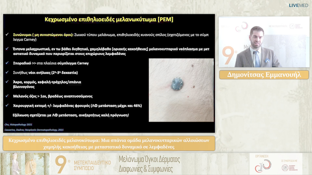 28 Ε. Δημονίτσας - Νεότερα δεδομένα στην διαχείριση ασθενών με ακανθοκυτταρικό καρκίνωμα δέρματος υψηλού κινδύνου: Η σημασία του υπέρηχου των περιοχικών λεμφαδένων, της κυτταρολογικής εξέτασης τους και της βιοψίας του λεμφαδένα φρουρού στην καλύτερη σταδι