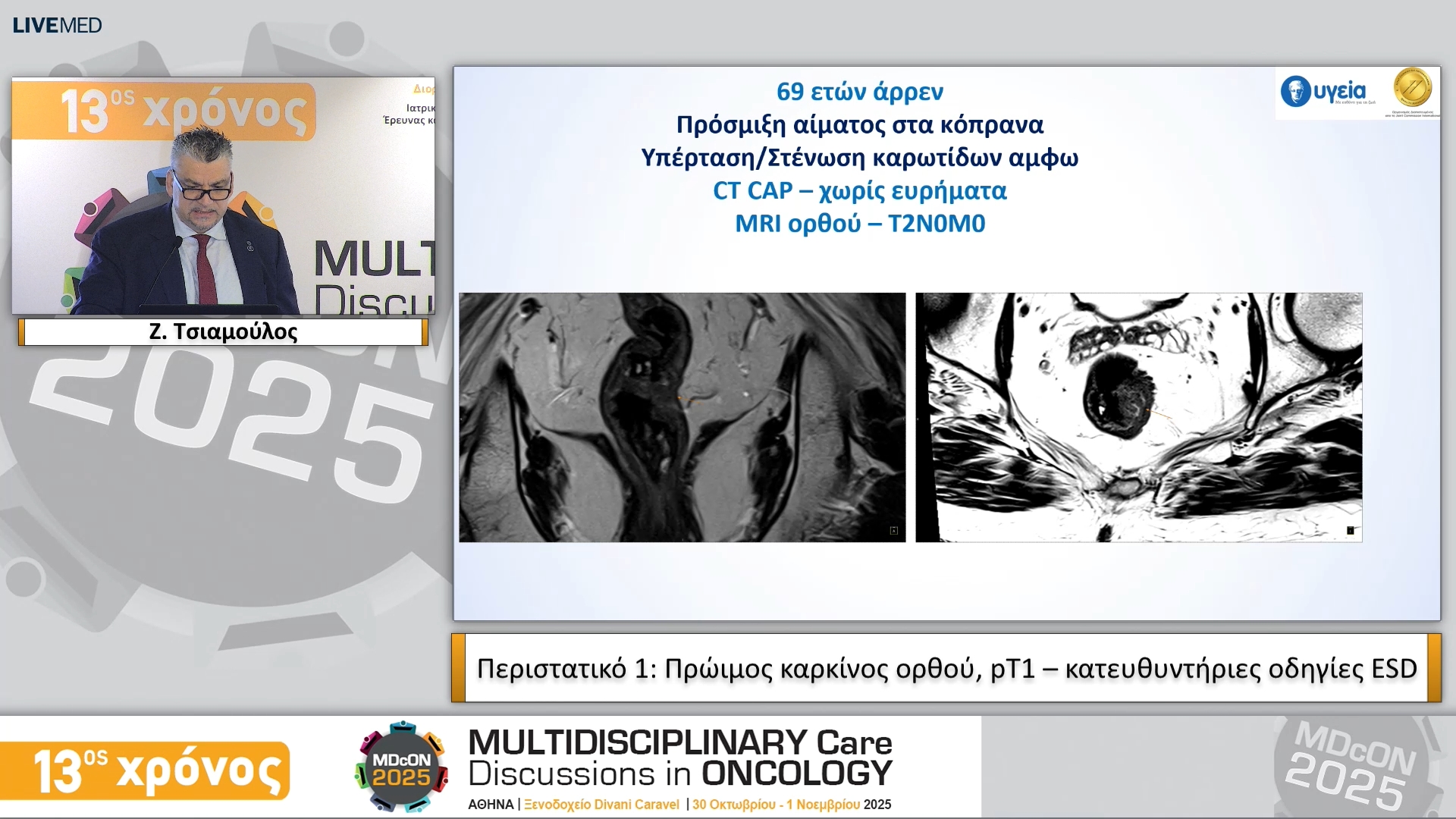 54 Ζ. Τσιαμούλος • Περιστατικό 1: Πρώιμος καρκίνος ορθού, pT1 – κατευθυντήριες οδηγίες ESD 