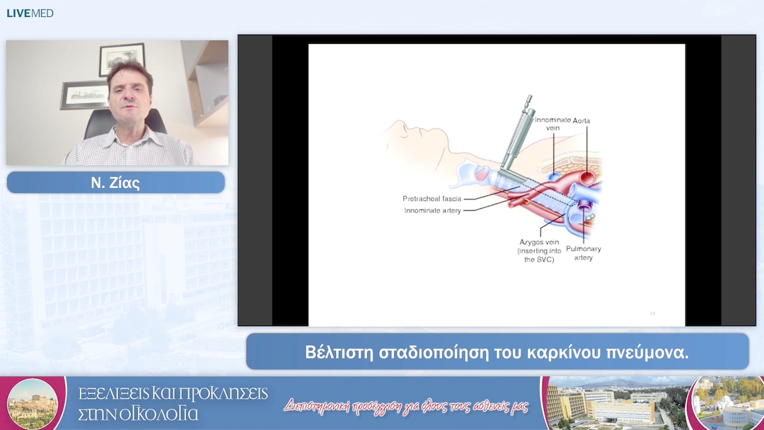 50 Ν. Ζίας - Βέλτιστη σταδιοποίηση του καρκίνου πνεύμονα.