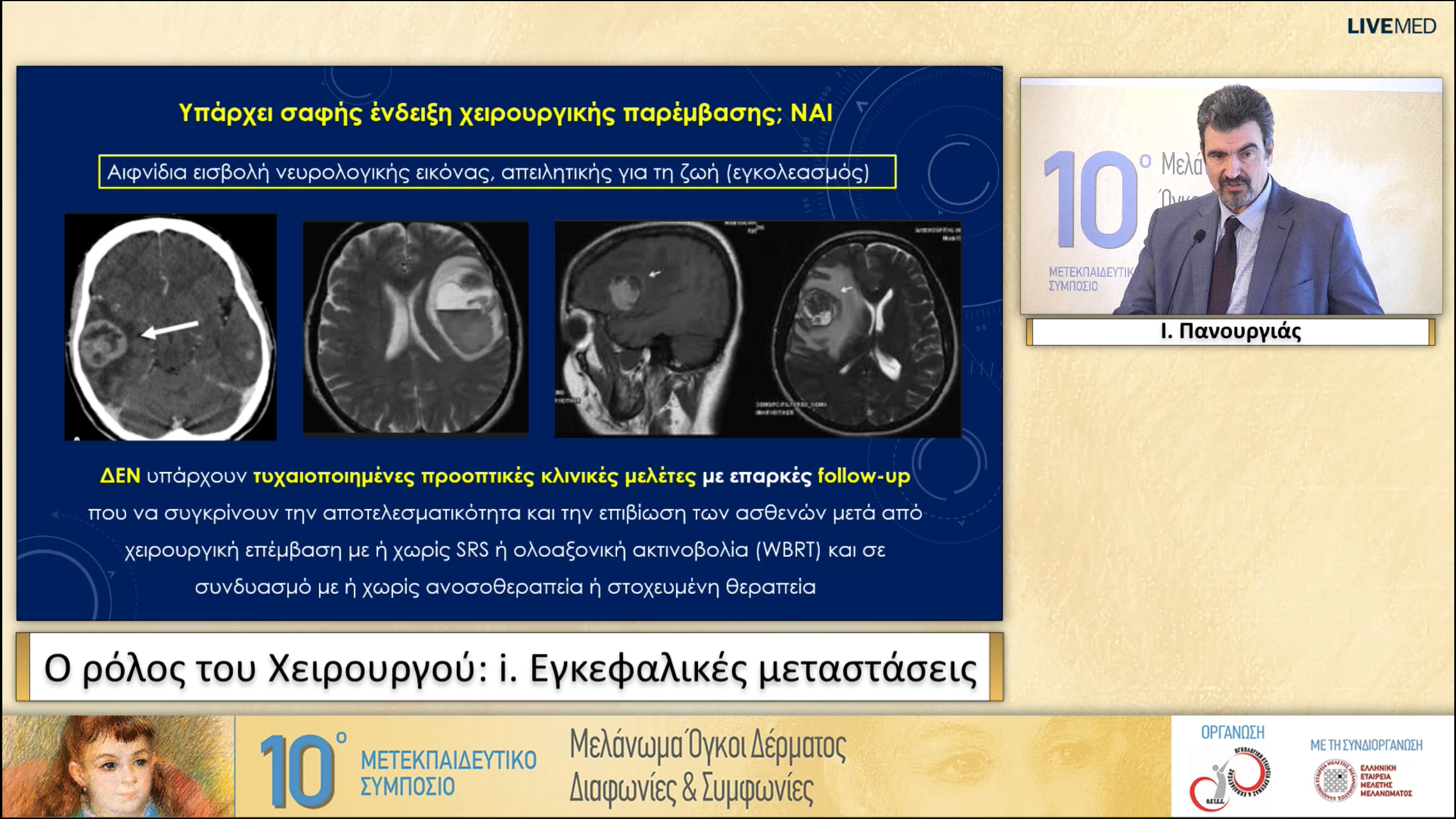 45 I. Πανουργιάς -  Εγκεφαλικές μεταστάσεις