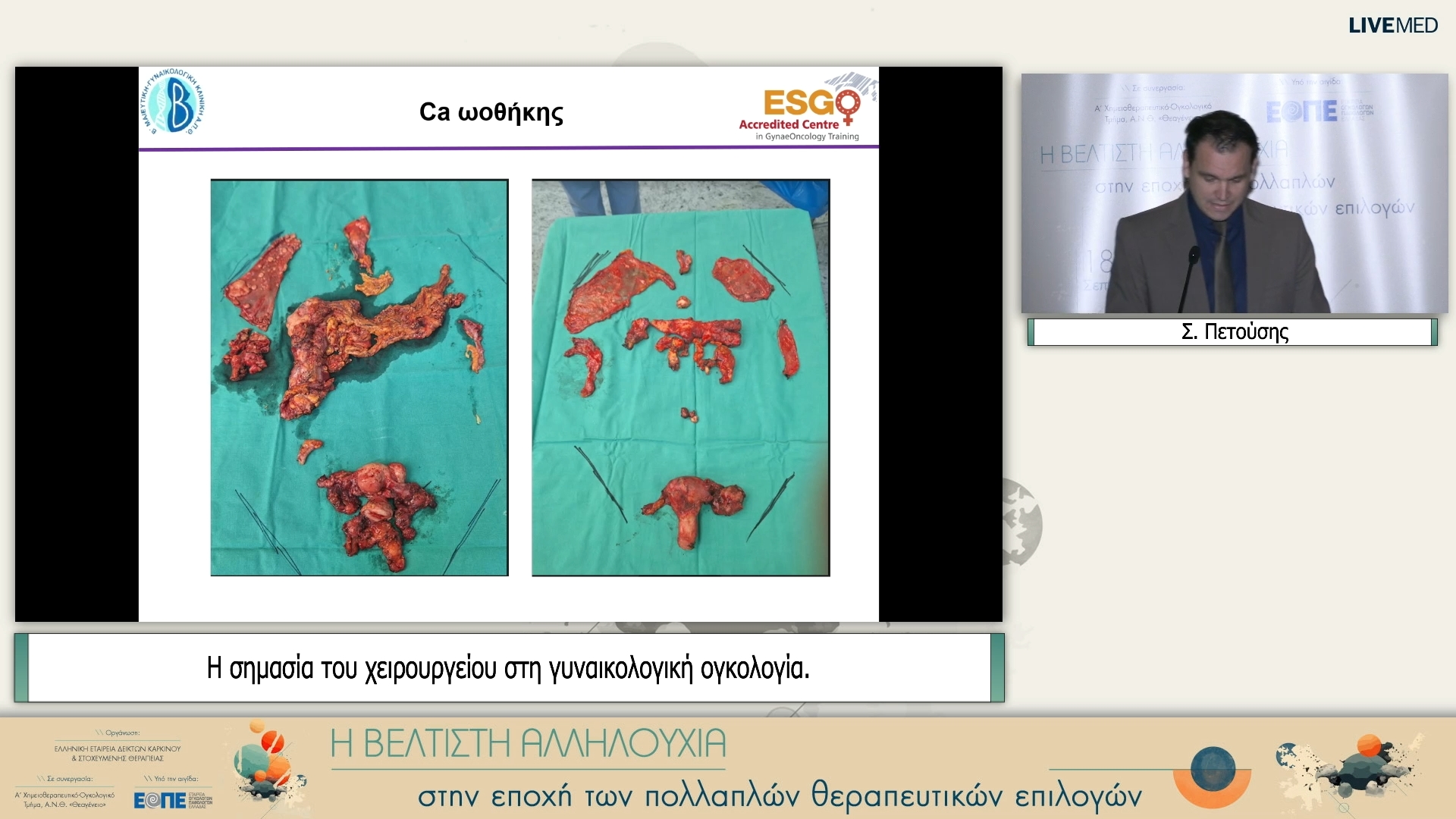 36 Σ. Πετούσης - Η σημασία του χειρουργείου στη γυναικολογική ογκολογία. 