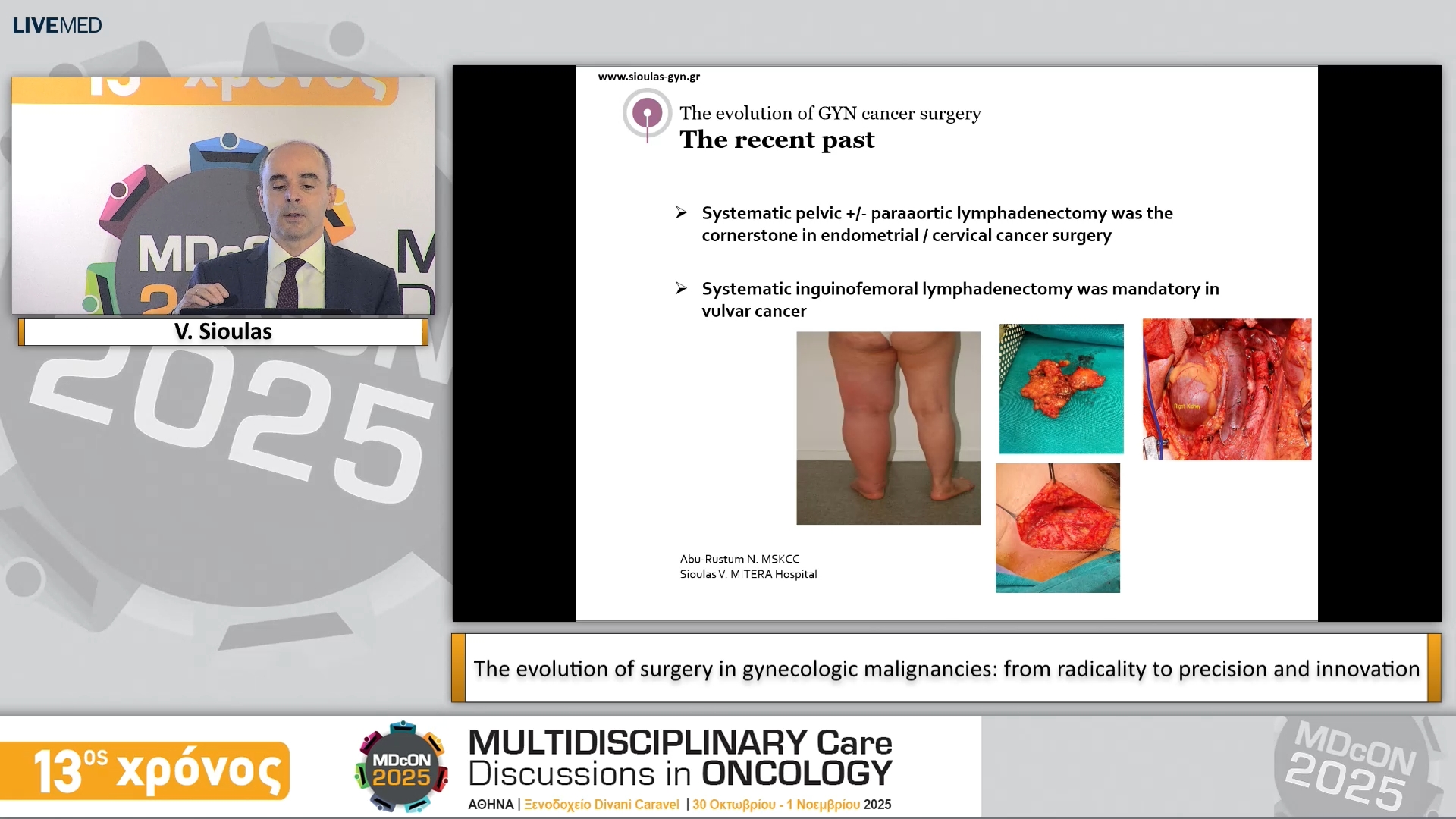68 V. Sioulas - The evolution of surgery in gynecologic malignancies: from radicality to precision and innovation