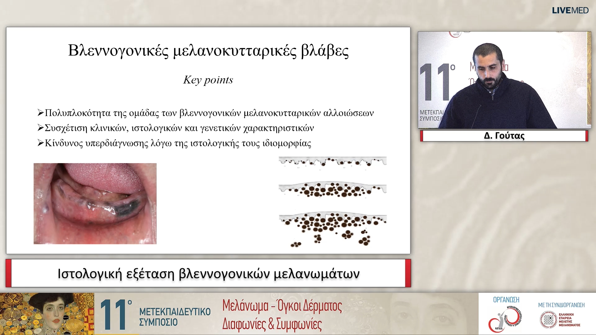 06 Δ. Γούτας - Ιστολογική εξέταση βλεννογονικών μελανωμάτων