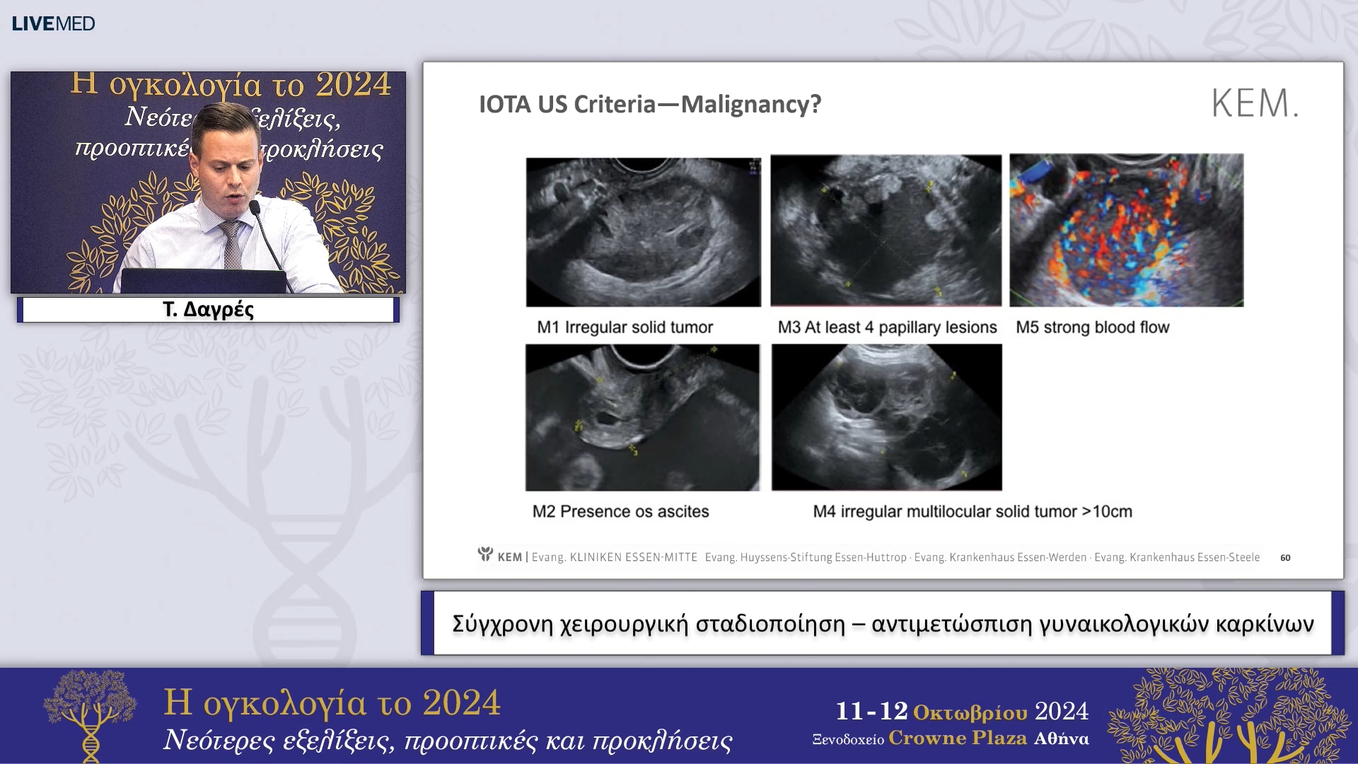 23 Τ. Δαγρές - Σύγχρονη χειρουργική σταδιοποίηση – αντιμετώσπιση γυναικολογικών καρκίνων 