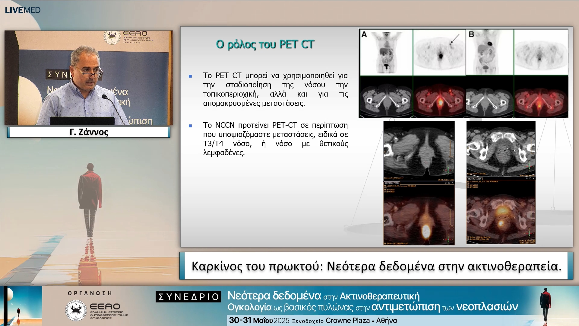41 Γ. Ζάννος - Καρκίνος του πρωκτού: Νεότερα δεδομένα στην ακτινοθεραπεία.