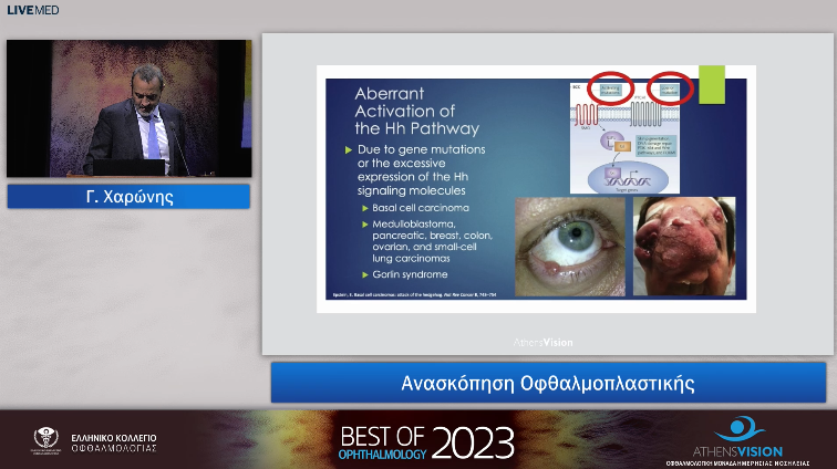 19 Γ. Χαρώνης - Ανασκόπηση Οφθαλμοπλαστικής 