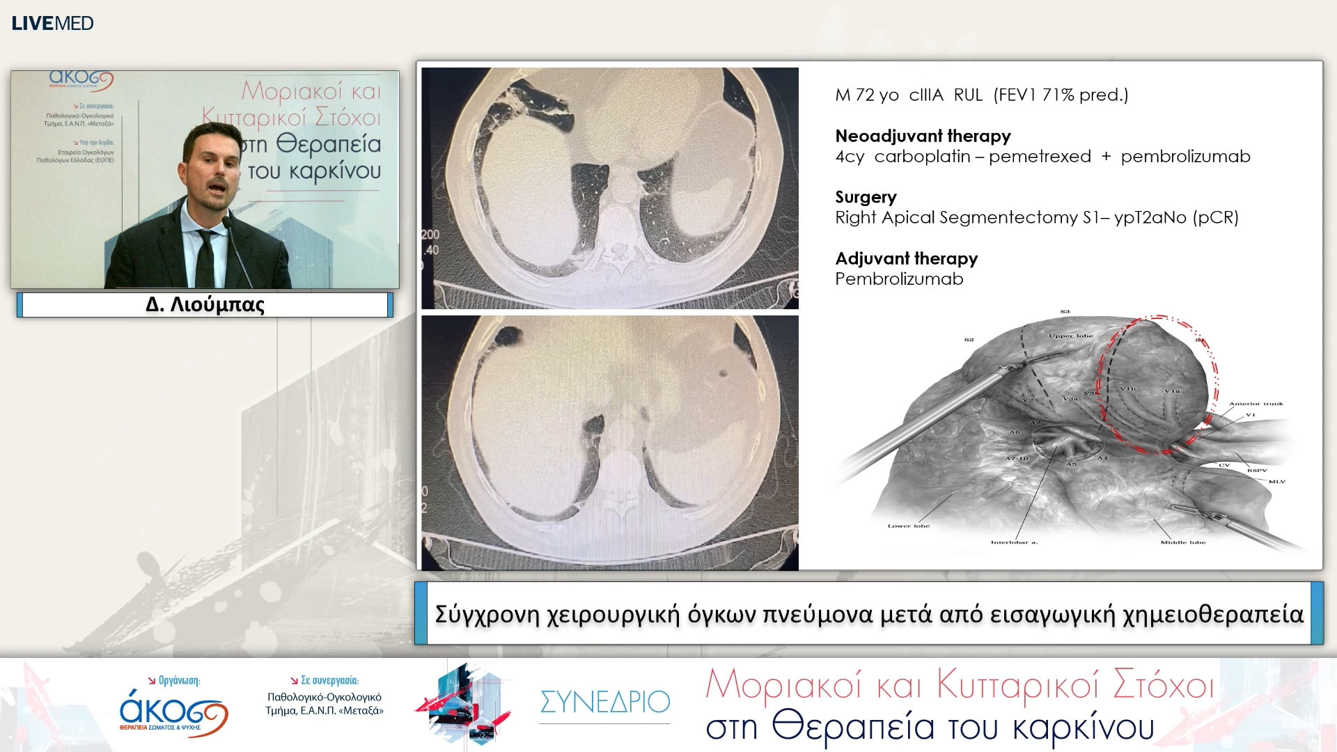 29 Δ. Λιούμπας - Σύγχρονη χειρουργική όγκων πνεύμονα μετά από εισαγωγική χημειοθεραπεία 
