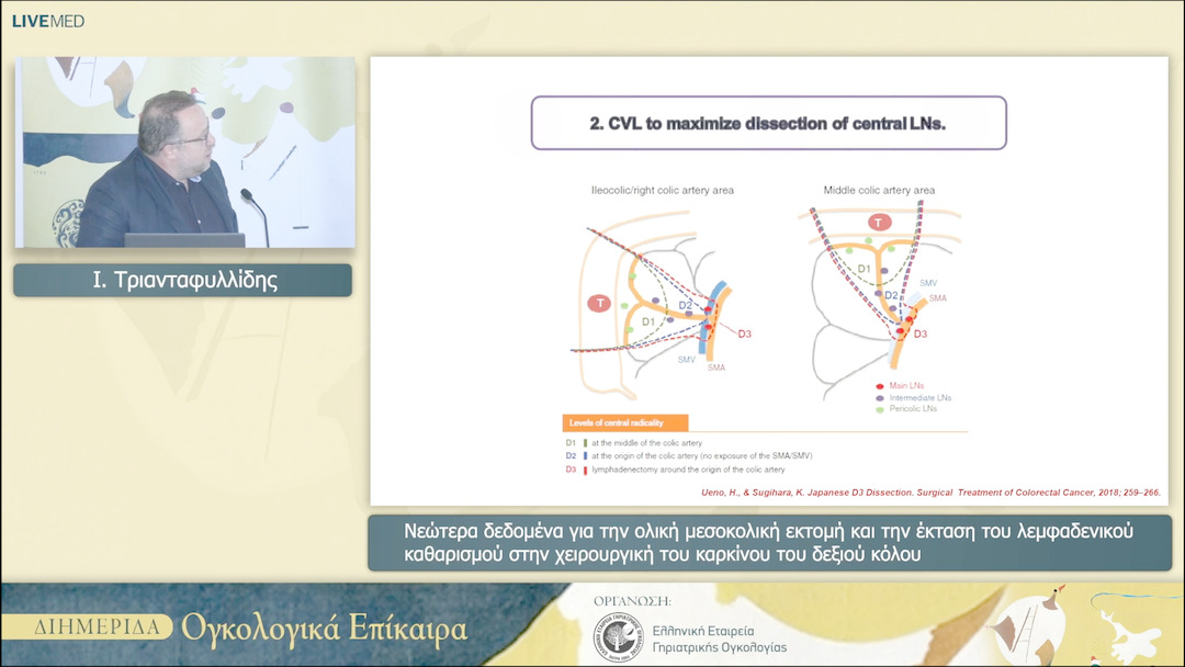 33 Ι. Τριανταφυλλίδης - Νεώτερα δεδομένα για την ολική μεσοκολική εκτομή και την έκταση του λεμφαδενικού καθαρισμού στην χειρουργική του καρκίνου του δεξιού κόλου 